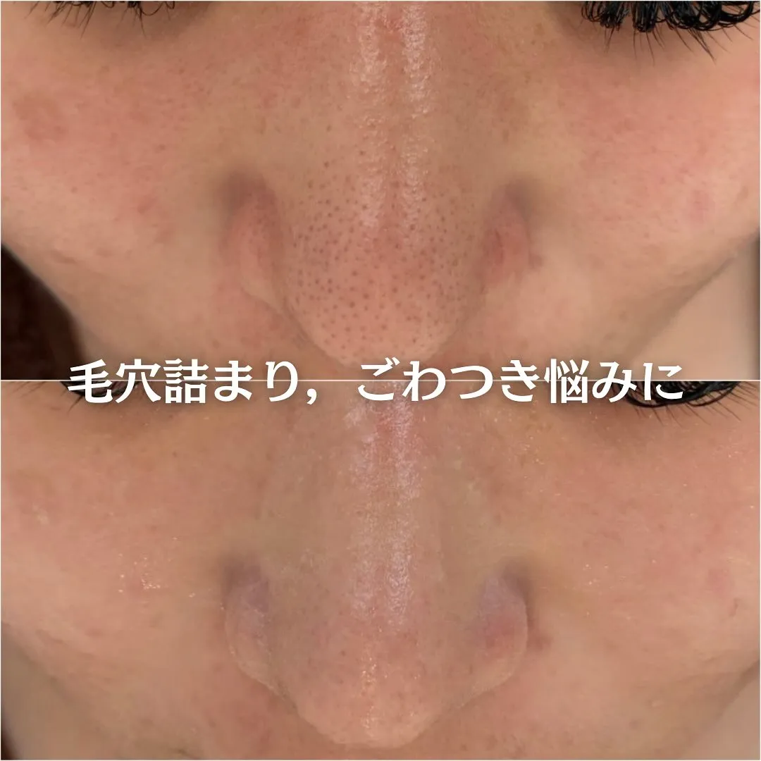 太田市にある頑固なニキビ専門店です✨️