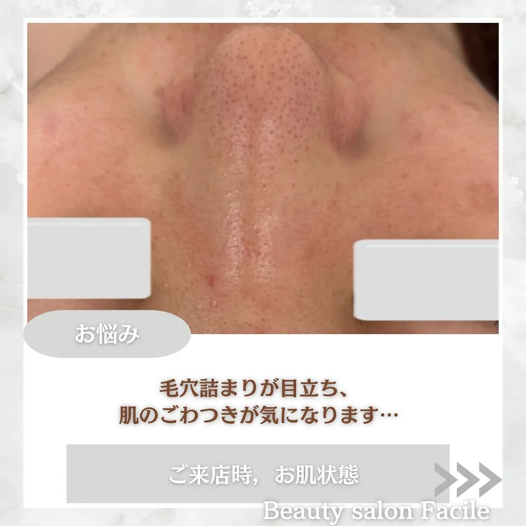 太田市にある頑固なニキビ専門店です✨️