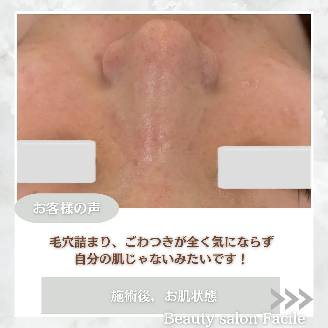 太田市にある頑固なニキビ専門店です✨️