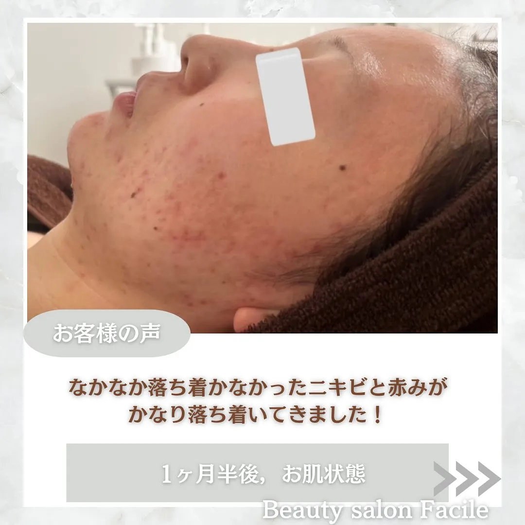 太田市にある頑固なニキビ専門店です✨️