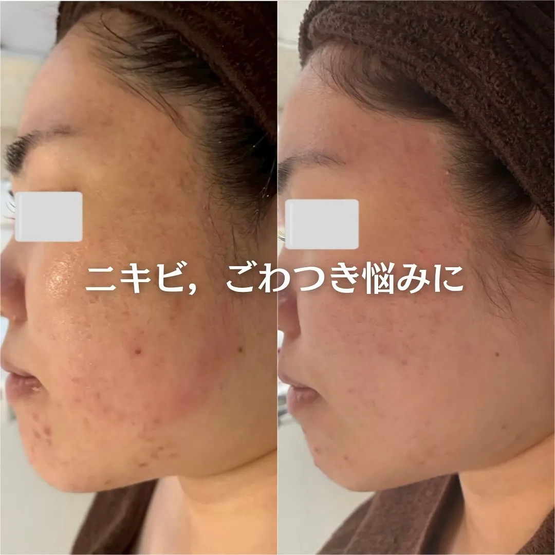 太田市にある頑固なニキビ専門店です✨️