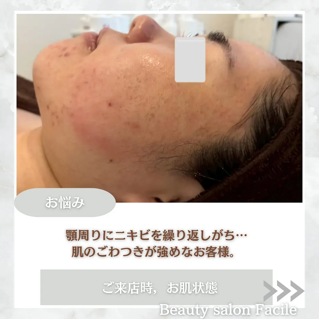 太田市にある頑固なニキビ専門店です✨️