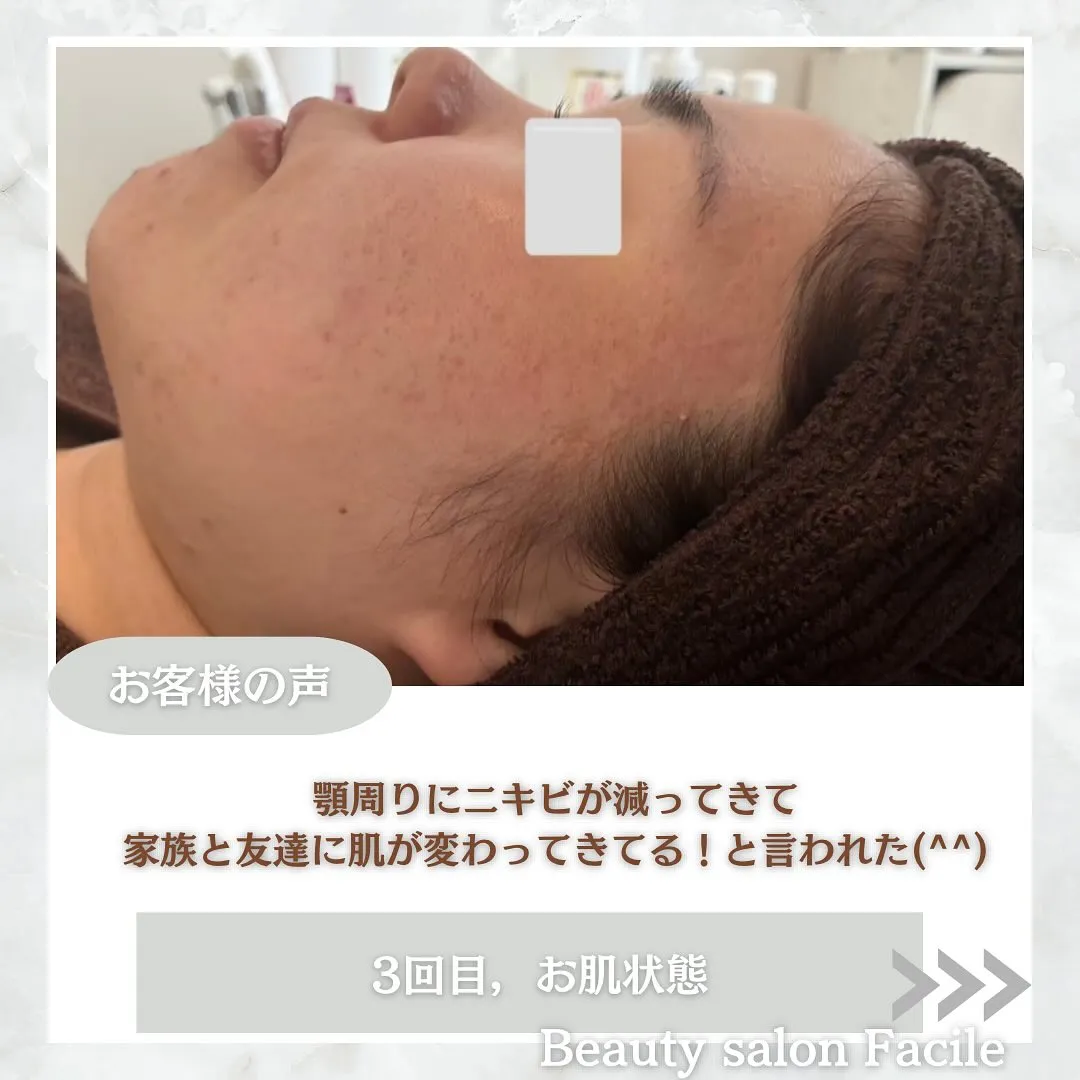 太田市にある頑固なニキビ専門店です✨️